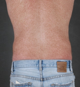 coolsculpting - patient 3643 - after 3 coolsculpting - patient 3643 - after 3