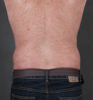coolsculpting - patient 3643 - before 3 coolsculpting - patient 3643 - before 3