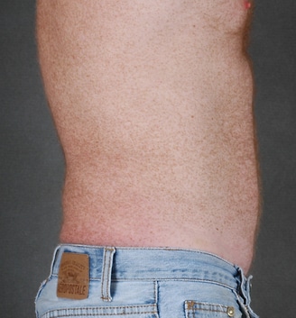 coolsculpting - patient 3643 - after 1 coolsculpting - patient 3643 - after 1