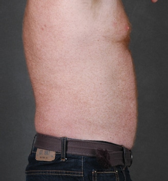 coolsculpting - patient 3643 - before 1 coolsculpting - patient 3643 - before 1