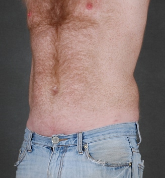 coolsculpting - patient 3643 - after 2 coolsculpting - patient 3643 - after 2