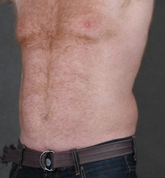 coolsculpting - patient 3643 - before 2 coolsculpting - patient 3643 - before 2