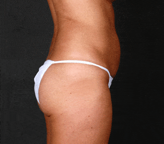 coolsculpting - patient 3653 - before 3 coolsculpting - patient 3653 - before 3