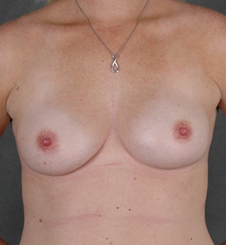 breast augmentation - patient 3689 - before 1 breast augmentation - patient 3689 - before 1