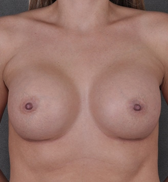 breast augmentation - patient 3697 - after 1 breast augmentation - patient 3697 - after 1