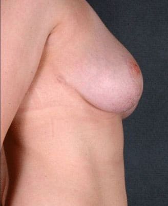 breast reduction - patient 6014 - after 3 breast reduction - patient 6014 - after 3