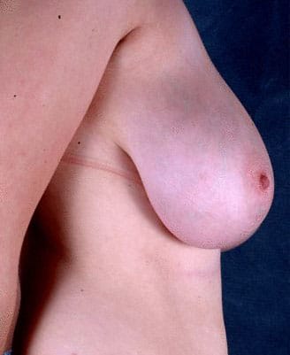 breast reduction - patient 6014 - before 3 breast reduction - patient 6014 - before 3