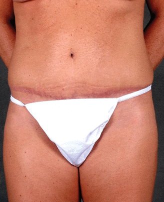 breast augmentation - patient 4992 - after 4 breast augmentation - patient 4992 - after 4