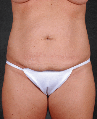 breast augmentation - patient 4992 - before 4 breast augmentation - patient 4992 - before 4