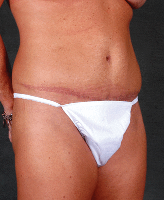 breast augmentation - patient 4992 - after 5 breast augmentation - patient 4992 - after 5