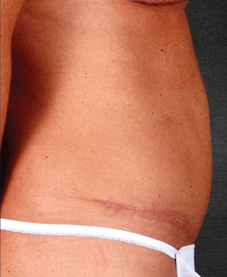 breast augmentation - patient 4992 - after 6 breast augmentation - patient 4992 - after 6