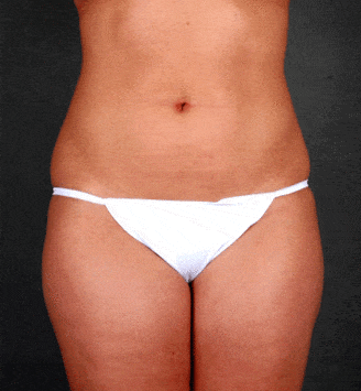 liposuction - patient 3940 - before 3 liposuction - patient 3940 - before 3
