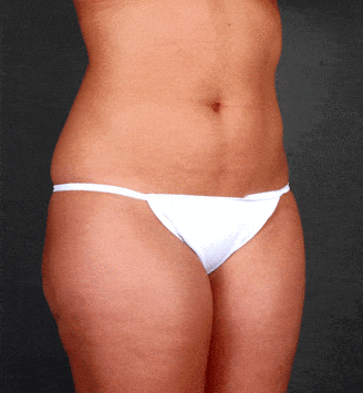 liposuction - patient 3940 - before 4 liposuction - patient 3940 - before 4
