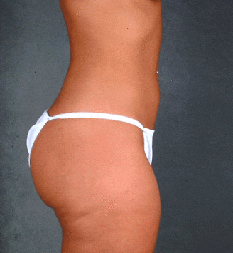 liposuction - patient 3940 - after 5 liposuction - patient 3940 - after 5