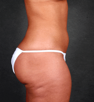 liposuction - patient 3940 - before 5 liposuction - patient 3940 - before 5