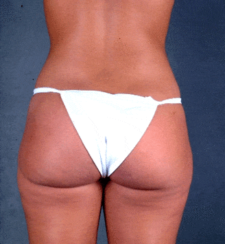 liposuction - patient 3940 - after 6 liposuction - patient 3940 - after 6