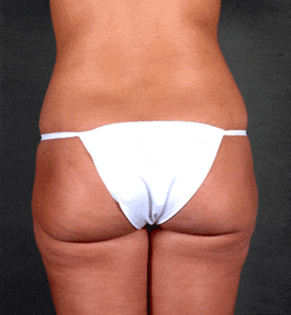 liposuction - patient 3940 - before 6 liposuction - patient 3940 - before 6