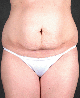 tummy tuck - patient 4976 - before 1 tummy tuck - patient 4976 - before 1