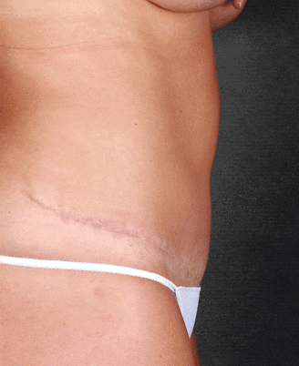 tummy tuck - patient 4976 - after 2 tummy tuck - patient 4976 - after 2