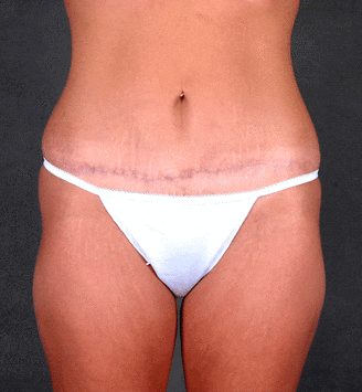 breast lift - patient 5740 - after 2 breast lift - patient 5740 - after 2