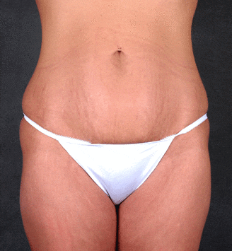 breast lift - patient 5740 - before 2 breast lift - patient 5740 - before 2