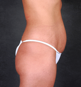 breast lift - patient 5740 - before 3 breast lift - patient 5740 - before 3