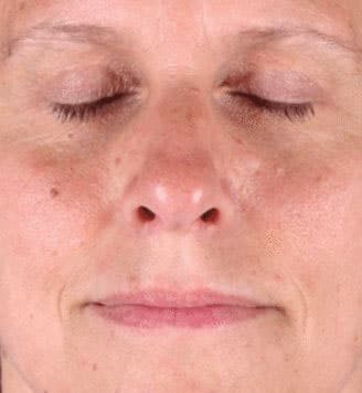 blepharoplasty - patient 5471 - after 1 blepharoplasty - patient 5471 - after 1