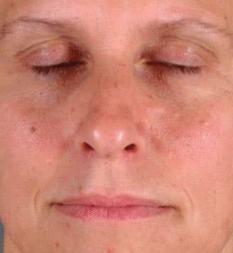 blepharoplasty - patient 5471 - before 1 blepharoplasty - patient 5471 - before 1