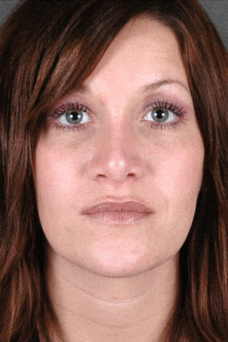 rhinoplasty - patient 5912 - after 1 rhinoplasty - patient 5912 - after 1