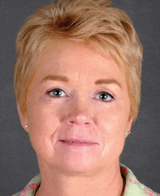 facelift - patient 5627 - after 1 facelift - patient 5627 - after 1