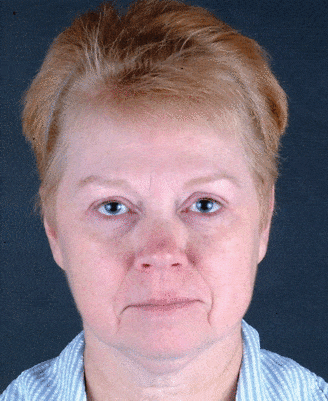 facelift - patient 5627 - before 1 facelift - patient 5627 - before 1