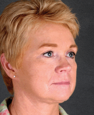 facelift - patient 5627 - after 2 facelift - patient 5627 - after 2