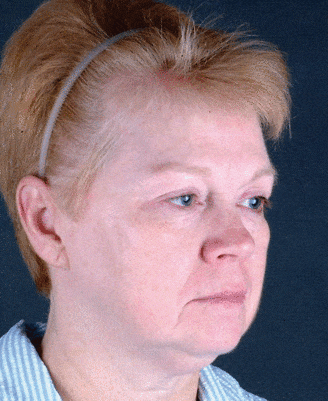 facelift - patient 5627 - before 2 facelift - patient 5627 - before 2