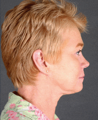 facelift - patient 5627 - after 3 facelift - patient 5627 - after 3