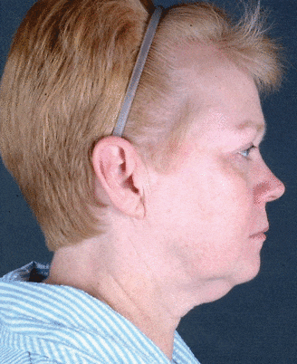 facelift - patient 5627 - before 3 facelift - patient 5627 - before 3