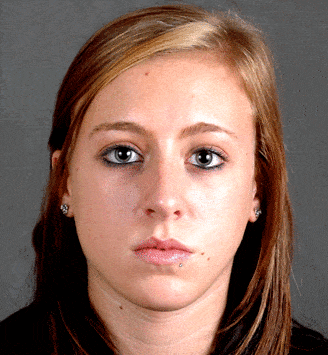 rhinoplasty - patient 5845 - before 1 rhinoplasty - patient 5845 - before 1