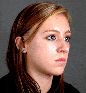 rhinoplasty - patient 5845 - before 2 rhinoplasty - patient 5845 - before 2