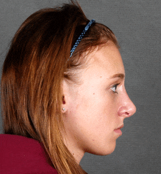 rhinoplasty - patient 5845 - after 3 rhinoplasty - patient 5845 - after 3