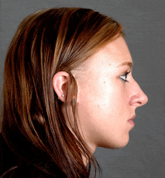 rhinoplasty - patient 5845 - before 3 rhinoplasty - patient 5845 - before 3