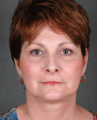 facelift - patient 5623 - after 1 facelift - patient 5623 - after 1
