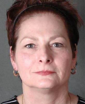 facelift - patient 5623 - before 1 facelift - patient 5623 - before 1