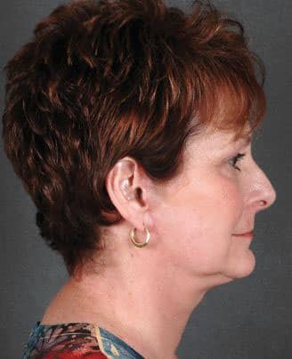 facelift - patient 5623 - after 2 facelift - patient 5623 - after 2