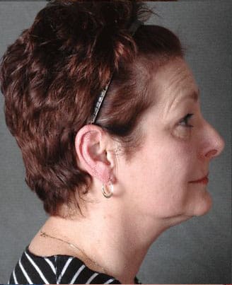 facelift - patient 5623 - before 2 facelift - patient 5623 - before 2