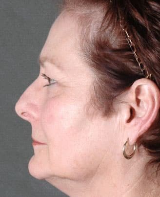 facelift - patient 5623 - before 3 facelift - patient 5623 - before 3