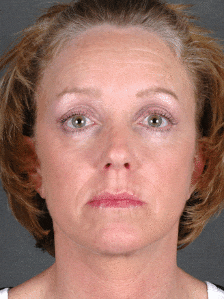 browlift - patient 5522 - after 1 browlift - patient 5522 - after 1