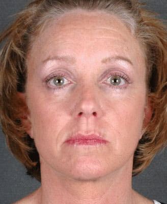 blepharoplasty - patient 5338 - after 1 blepharoplasty - patient 5338 - after 1