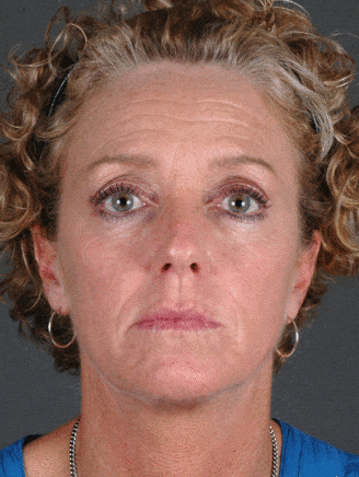 browlift - patient 5522 - before 1 browlift - patient 5522 - before 1