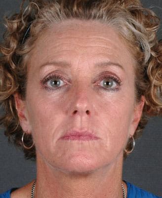blepharoplasty - patient 5338 - before 1 blepharoplasty - patient 5338 - before 1