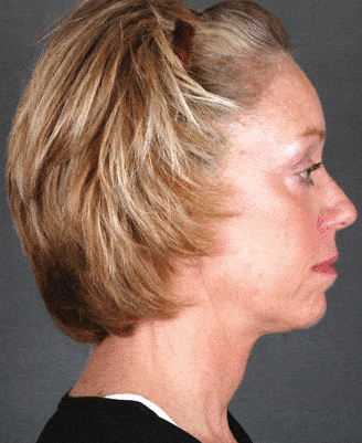 browlift - patient 5522 - after 2 browlift - patient 5522 - after 2