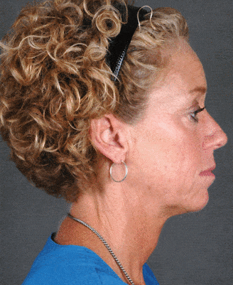 browlift - patient 5522 - before 2 browlift - patient 5522 - before 2